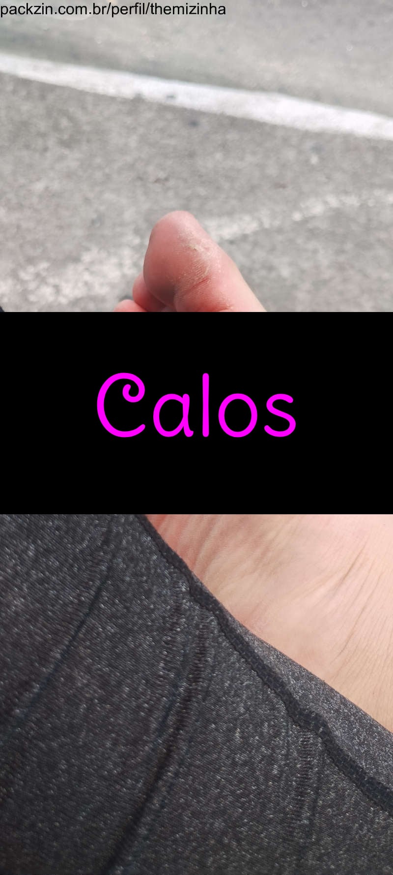 Imagem do pack Pés com calos 😔